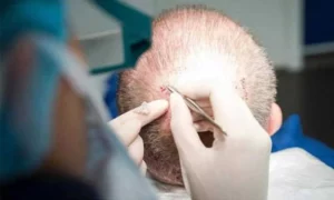 FUE Technique