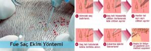Fue Technique Hair Transplant