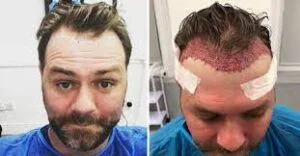 Haartransplantation