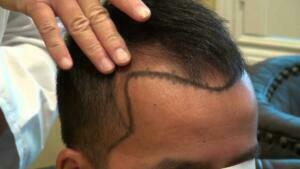 Hair Transplant Side Effects