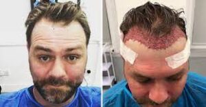 Hair Transplant Side Effects